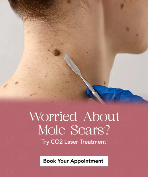 mole-removal-service-mobile.webp