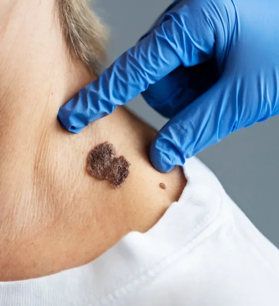 Mole Removal Treatment