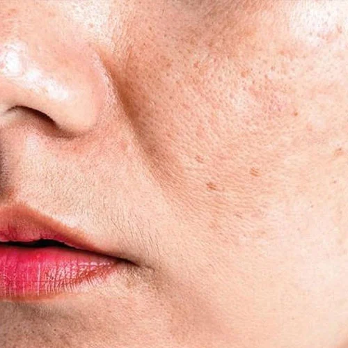 acne-scar