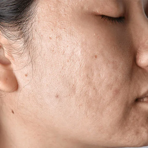 Pigmentation